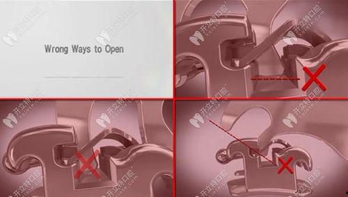 国产自锁托槽视频,革新口腔矫正技术，引领美丽微笑新潮流